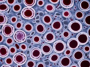 tularemia