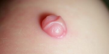 Guzek rzeżączki – co to jest i jakie ma znaczenie? Porady i ciekawostki guzek rzeżączki